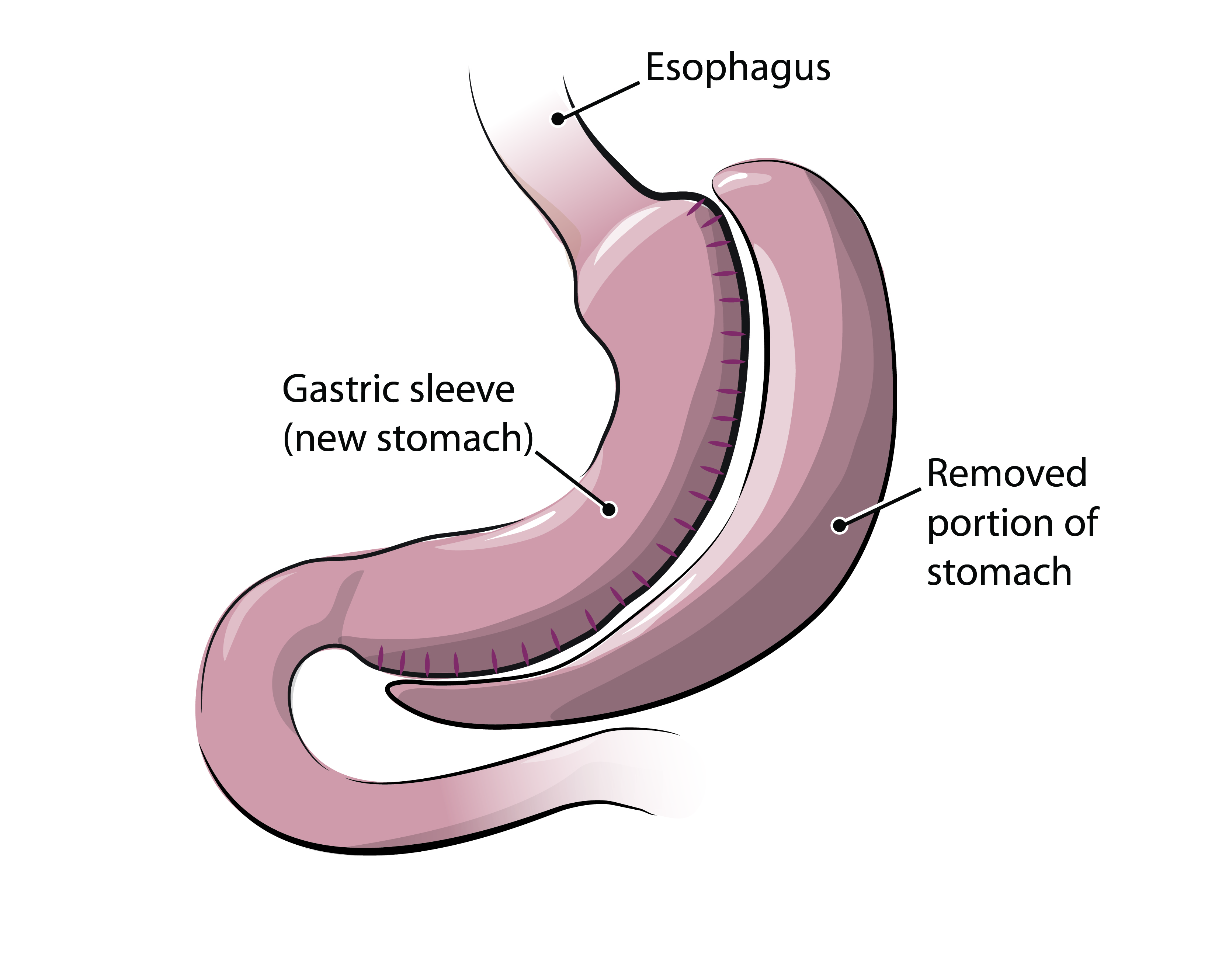 diet after gastric bypass