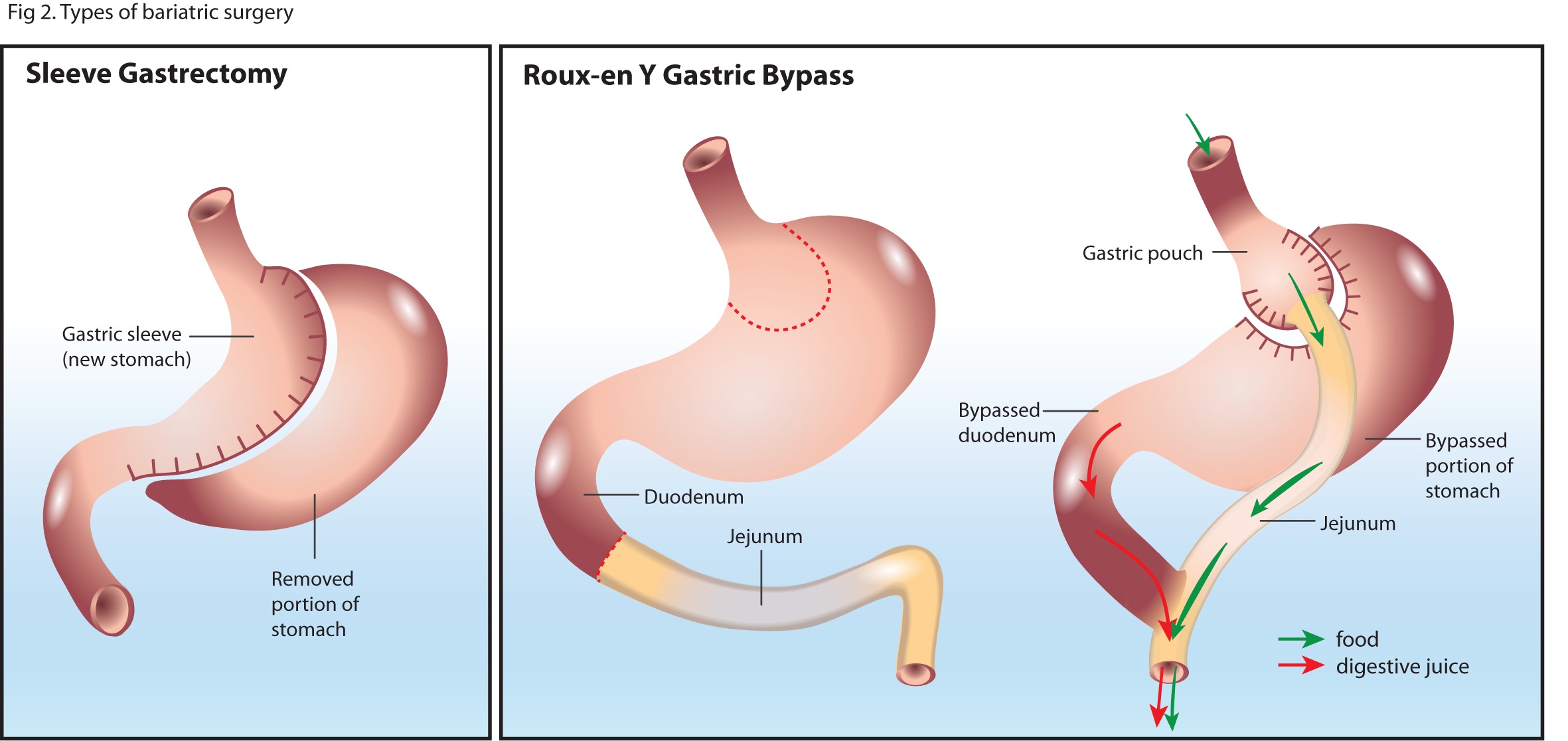 Types of gastric bypass surgery