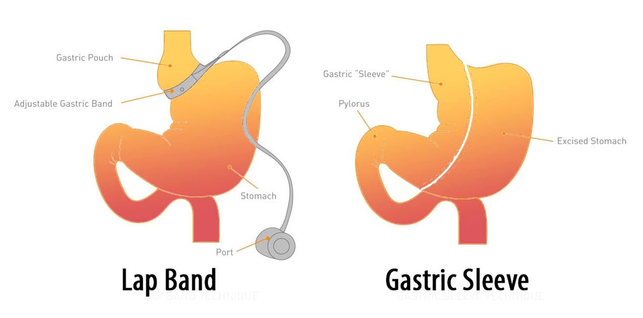 gastric sleeve vs lap band