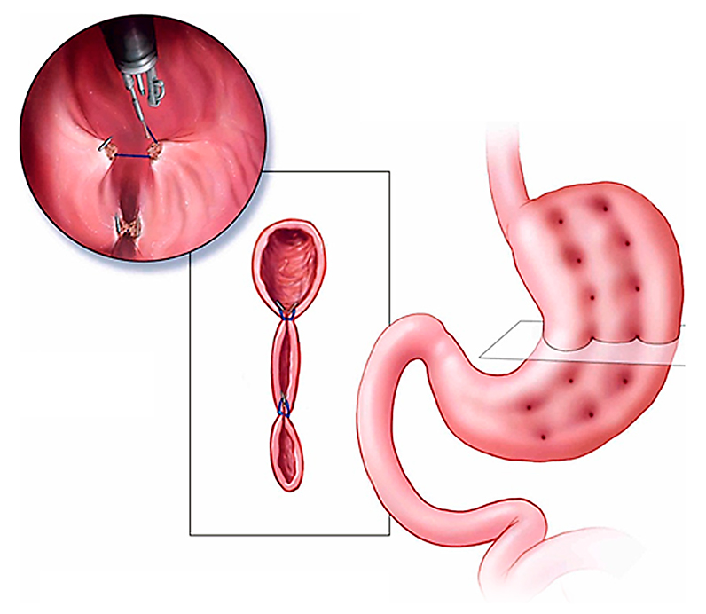 gastric sleeve surgery cost