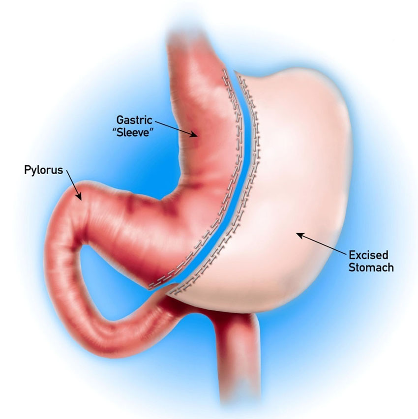 gastric sleeve surgery complications