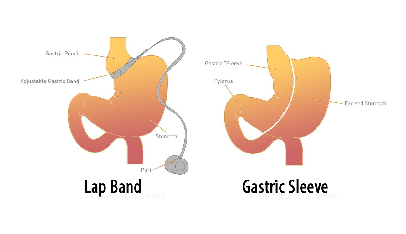 lap band conversion to gastric sleeve