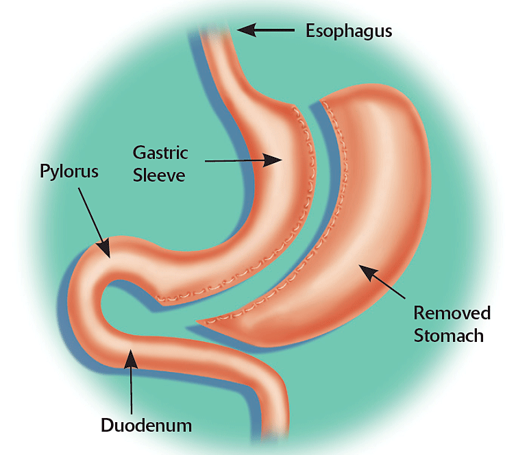 roux en y gastric bypass vs sleeve gastrectomy
