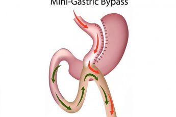 mini gastric bypass surgery